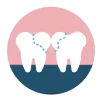Composite Bonding